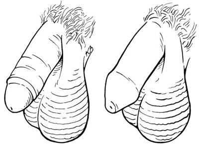 A circumcised penis <i>(l.) </i>with the foreskin removed; an uncircumcised penis <i>(r.)</i> with 