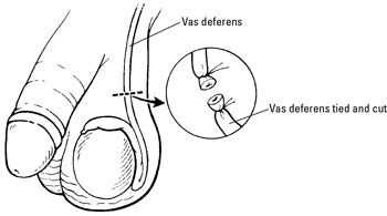 In a vasectomy, the tubes that carry the sperm are cut and tied.