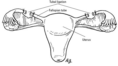 Cutting and tying off the fallopian tubes prevent sperm from reaching the egg.