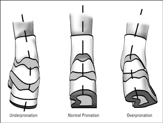 Buy running shoes that match your pronation.