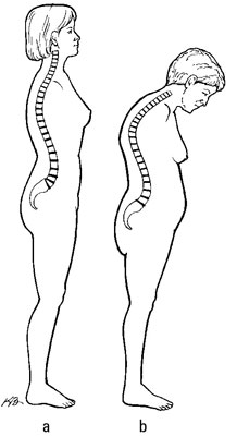 A normal spine (a) and a dowager’s hump (b).