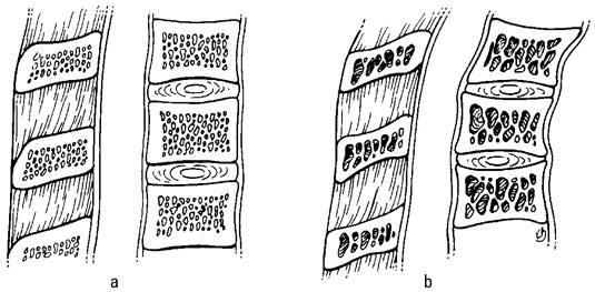 Healthy bones (a) are denser than bones affected by osteoporosis (b).