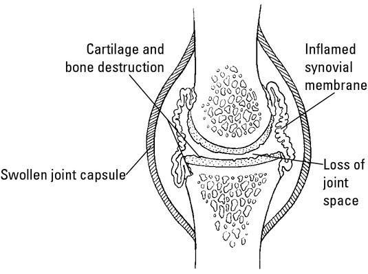 A synovial joint with inflammation in the synovial membrane.