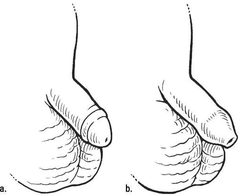 A circumcised penis (a) and an uncircumcised penis (b). [Credit: Illustration by Kathryn Born, MA]