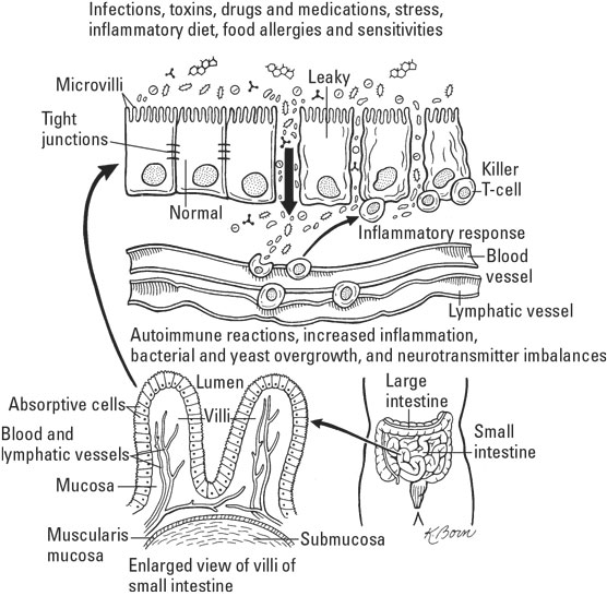 leaky gut syndrome