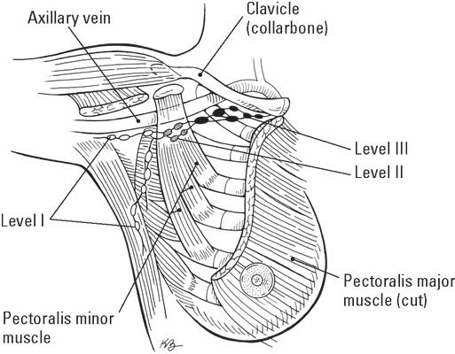 Axillary lymph node dissection