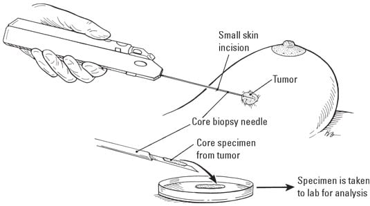 breast-biopsy