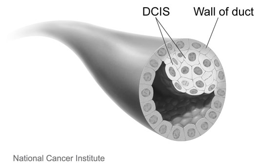 breast-dcis