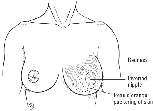 breast-inflammatory