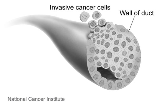 breast-invasive