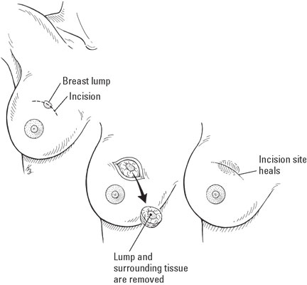 Lumpectomy or partial mastectomy (breast-conserving surgery)