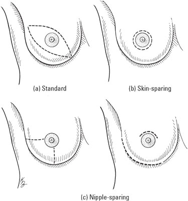 Mastectomy (total or simple)