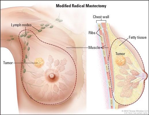 Modified radical mastectomy