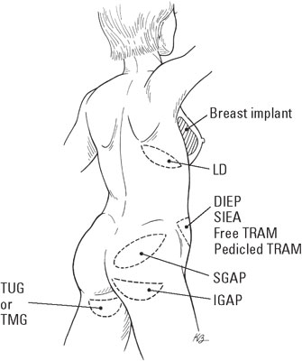 breast-reconstruction