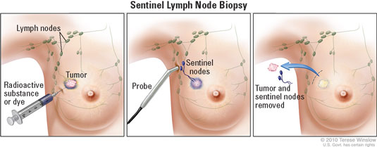 Sentinel lymph node biopsy