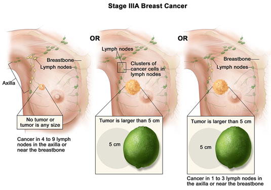 Stage IIIA