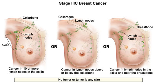 Stage IIIC