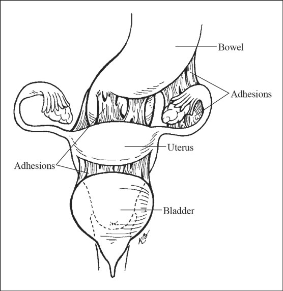 adhesions