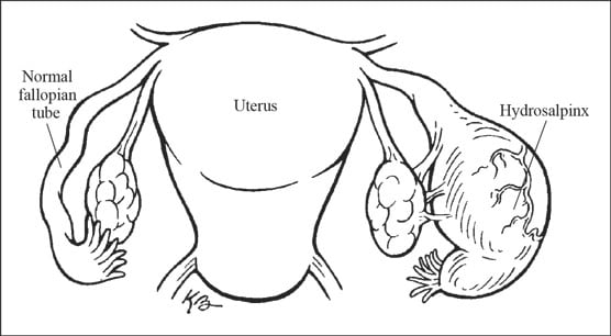 hydrosalpinx 
